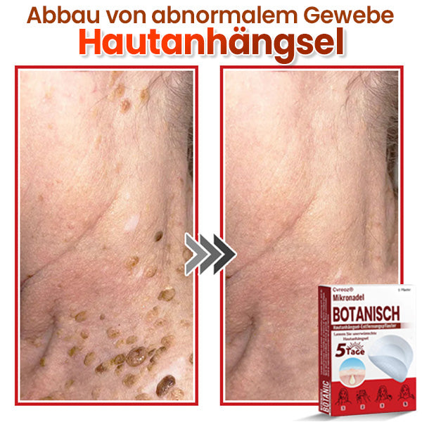 Cvreoz® Mikronadel Botanisches Hautanhängsel-Entfernungspflaster