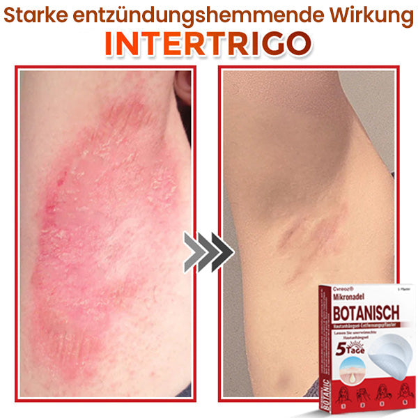 Cvreoz® Mikronadel Botanisches Hautanhängsel-Entfernungspflaster