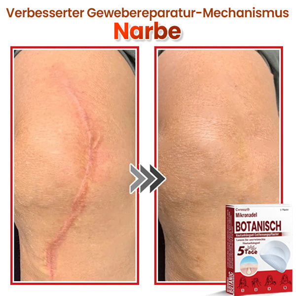 Cvreoz® Mikronadel Botanisches Hautanhängsel-Entfernungspflaster