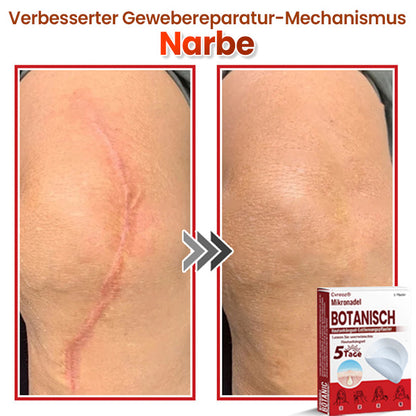 Cvreoz® Mikronadel Botanisches Hautanhängsel-Entfernungspflaster