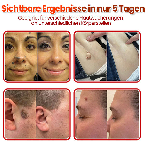 Cvreoz® Mikronadel Botanisches Hautanhängsel-Entfernungspflaster